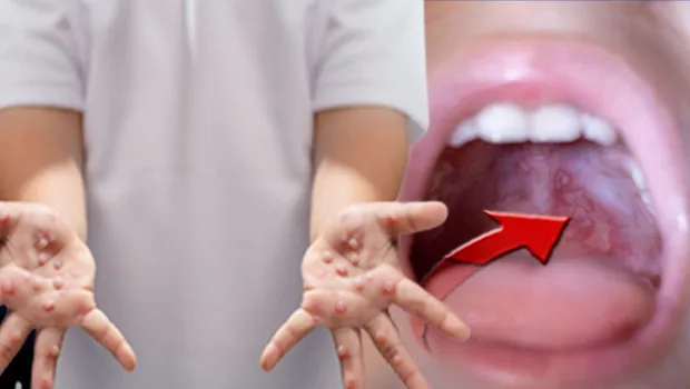 El Ayak Ağız Hastalığı Alarmı! Türkiye'de Durum Ne?