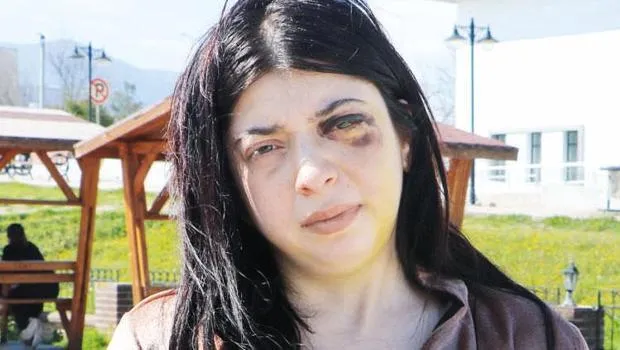 Sokak Ortasında Taciz! Damla'nın Yüzündeki Demir İzleri Şoke Etti